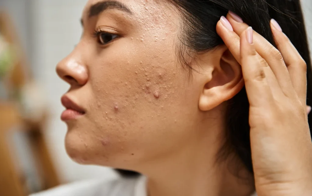 Acne and acne scars treatment in Lucknow - La Densitae