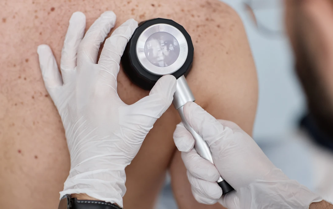 Dermatology Treatment - La Densitae Lucknow
