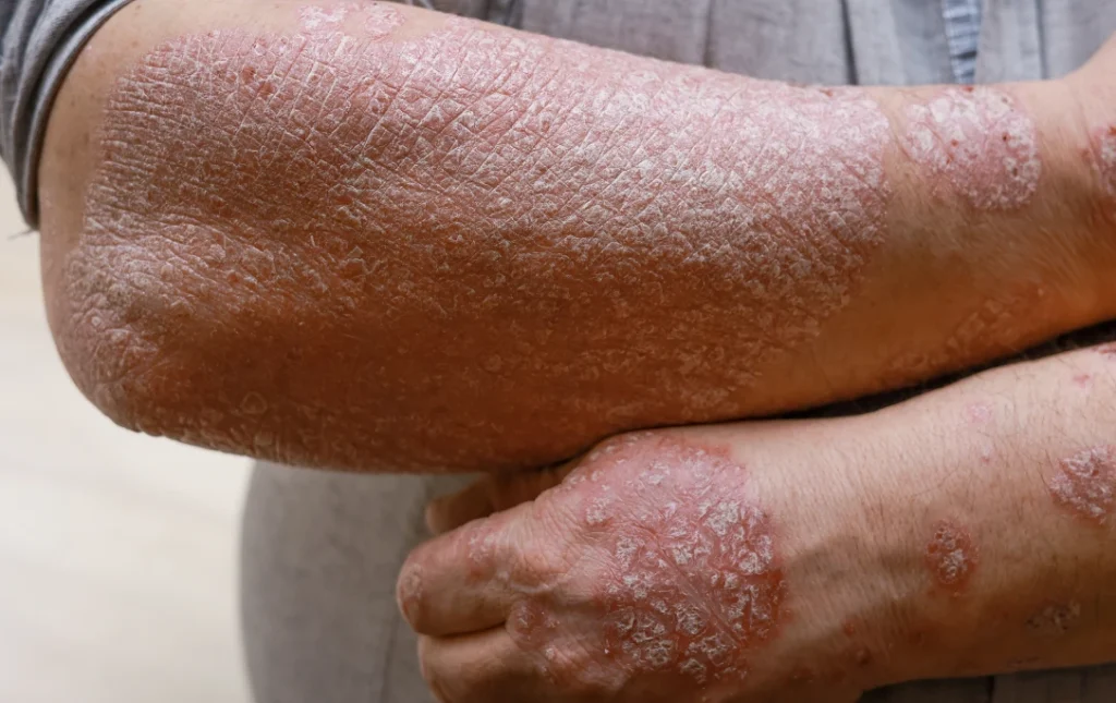 Eczema and psoriasis skin condition - La Densitae Lucknow