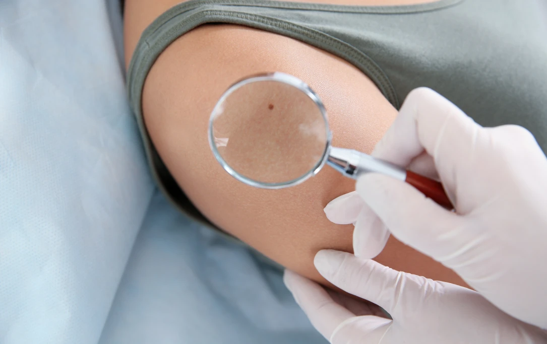 Dermatologist examining mole with magnifying glass - La Densitae Lucknow